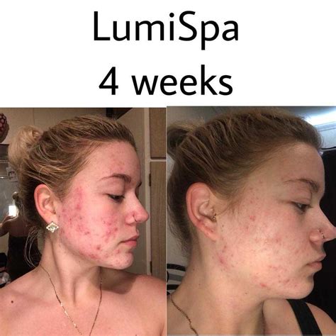 lumispa before and after acne|LumiSpa Review Before and After: The Truth About .